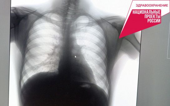 Заболеваемость туберкулезом в регионе снизилась на 23 процента