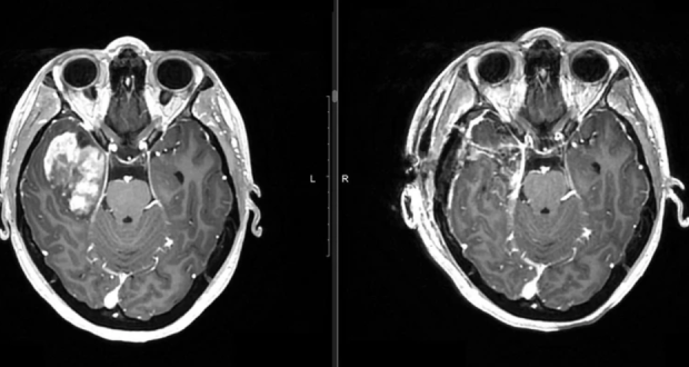 Новосибирские нейрохирурги спасли пациентку с опухолью головного мозга