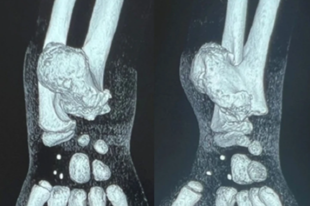 Новосибирские хирурги помогли маленькому омичу