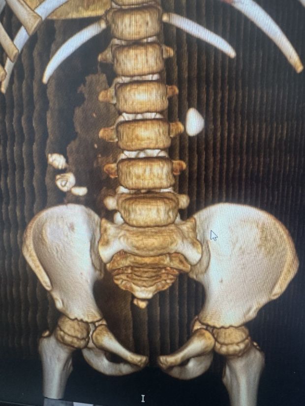 У 118 детей врачи удалили камни